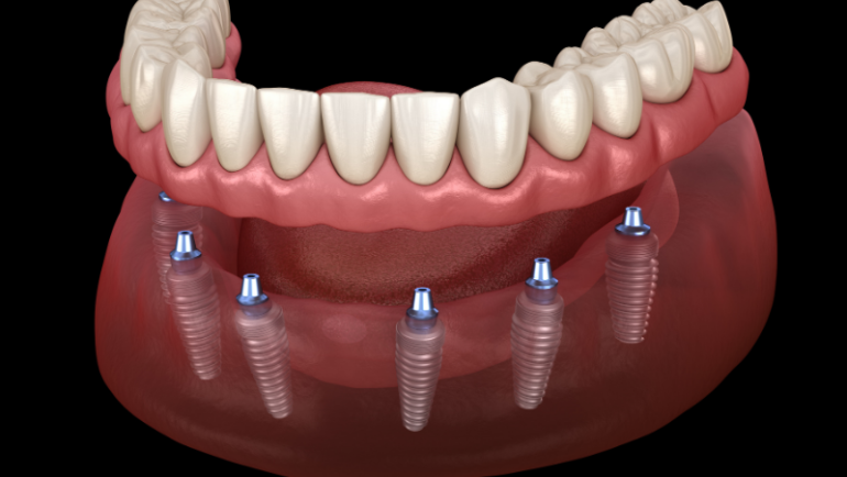 Impianti dentali Roma: le tecniche più affidabili e innovative