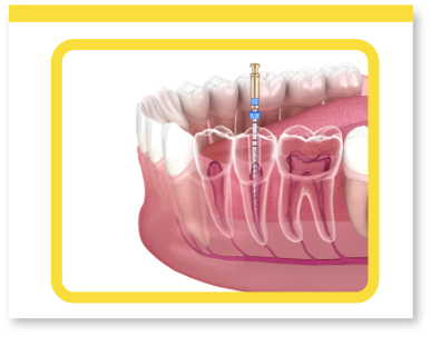 devitalizzazione dente costi